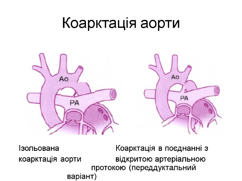 Коарктація аорти Ізольована   Коарктація в поєднанні з коарктація аорти  відкритою артеріальною